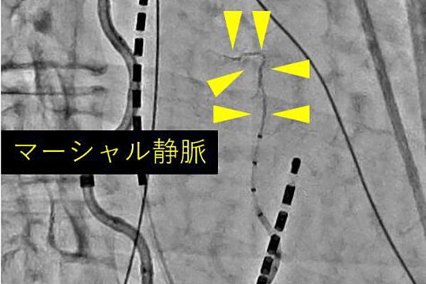 クライオバルーンによる冷凍アブレーション