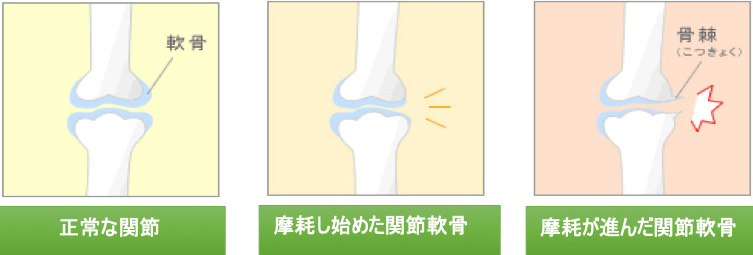 図：正常な関節、摩耗し始めた関節軟骨、摩耗が進んだ関節軟骨