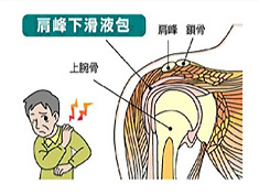 図：肩関節周囲炎