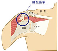 図：腱板断裂
