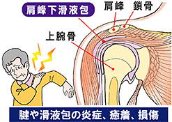 図：腱板炎