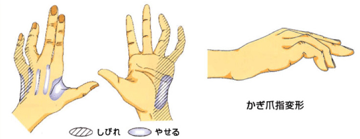 図：肘部管症候群