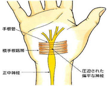 図：手関節（手根管）の構造・仕組み
