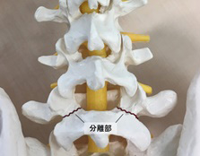 腰椎分離症