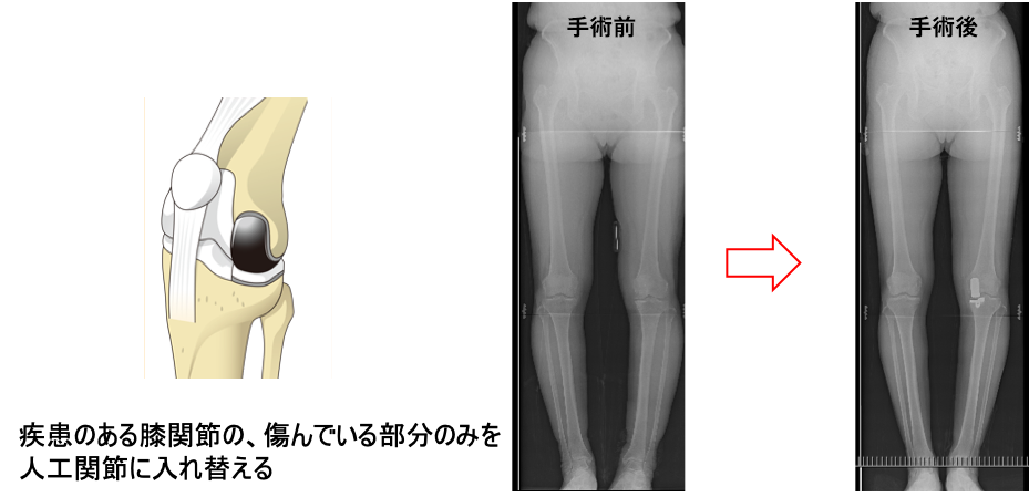 人工膝関節部分置換術（UKA）