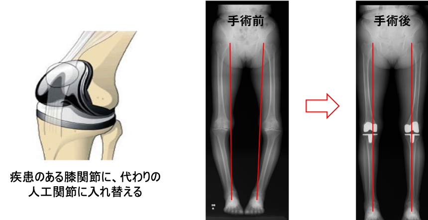 人工膝関節全置換術（TKA）
