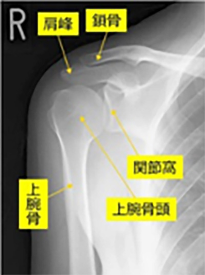 人工関節置換術（TSA）