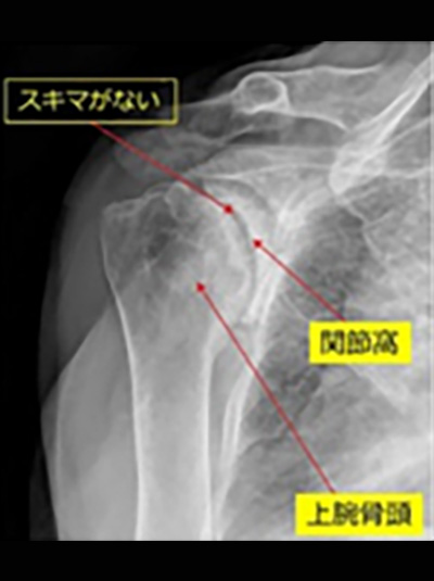 人工関節置換術（TSA）