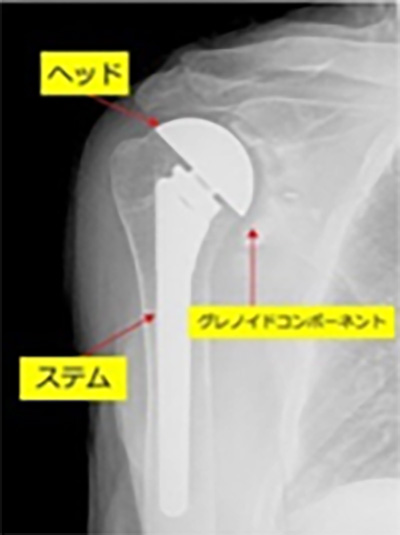 人工関節置換術（TSA）