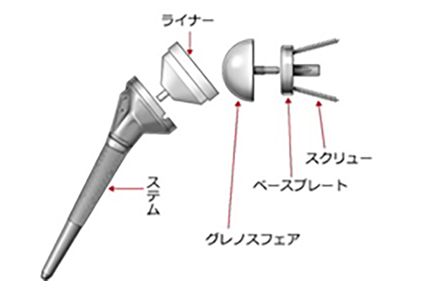 リバース型人工関節置換術