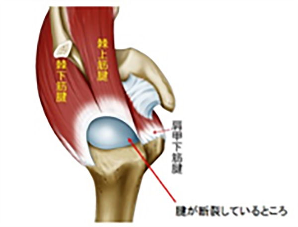 関節鏡下腱板修復術