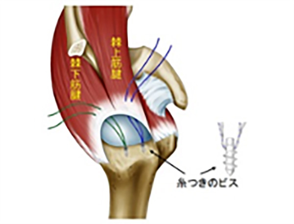 関節鏡下腱板修復術