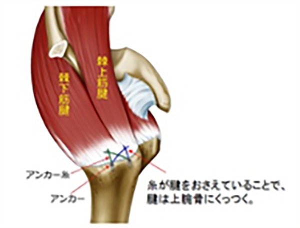 関節鏡下腱板修復術