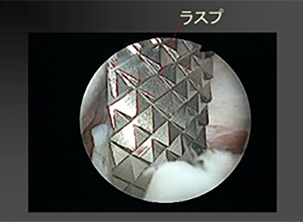 関節唇靭帯複合体を完全に関節窩から剥がす