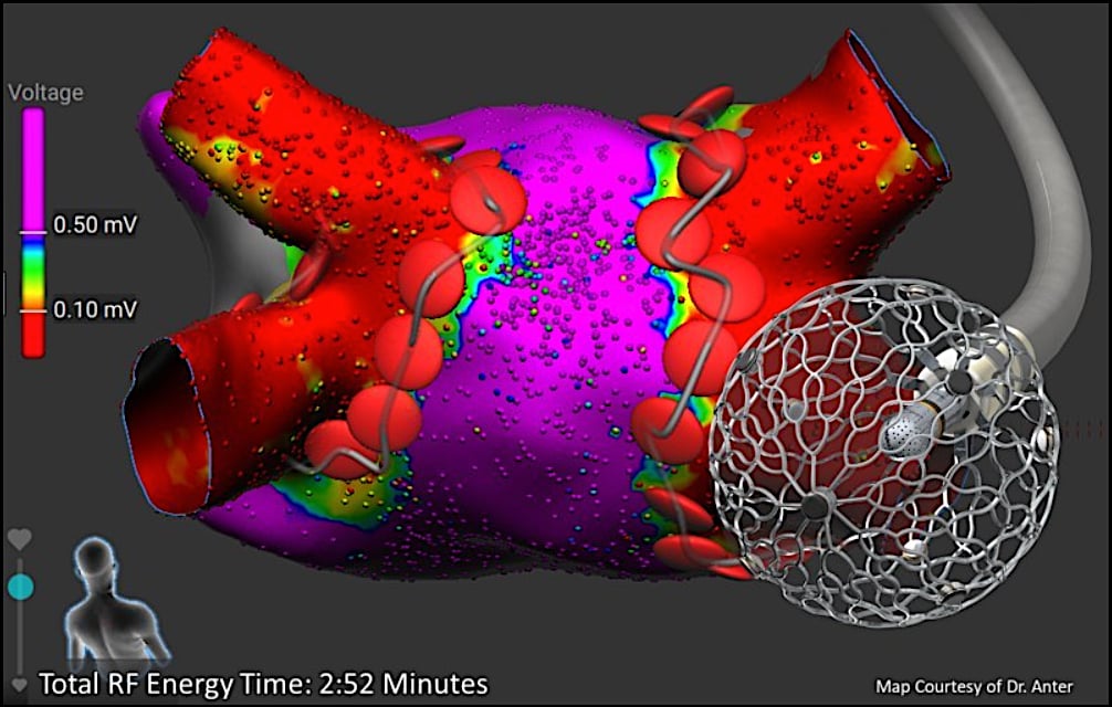 パルスフィールドアブレーション1