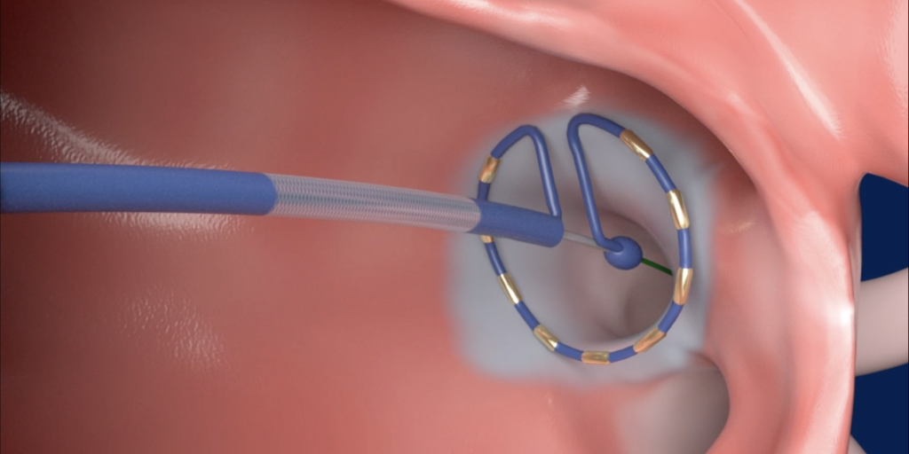 パルスフィールドアブレーション3