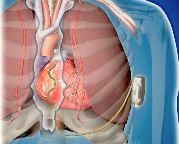 Medtronic_Extravascular_ICD_EV-ICD_system_0