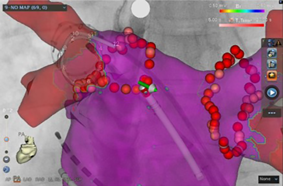 画像：不整脈のカテーテル治療