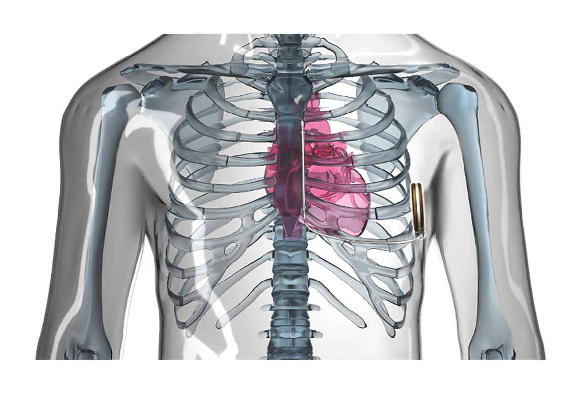 画像：皮下植え込み型除細動器（S-ICD）植え込みイメージ