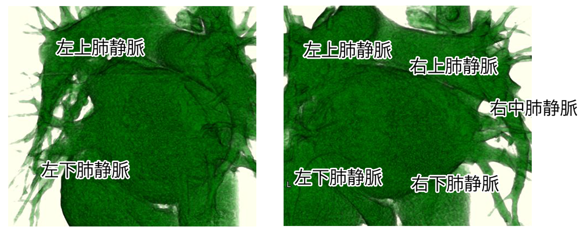 画像：術前のCT画像（造影剤未使用）