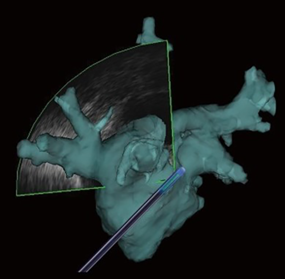 画像：不整脈のカテーテル治療