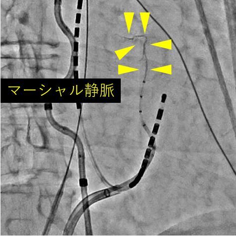 画像：クライオバルーンによる冷凍アブレーション